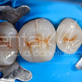 Composito dentale Dentalmax Volvera