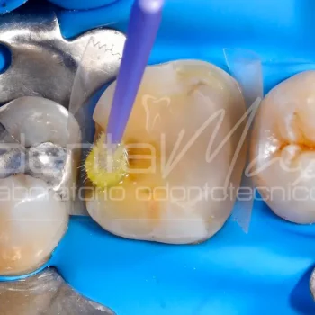 Composito dentale Dentalmax Volvera