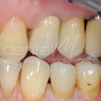 corona dentale in zirconio su impianto