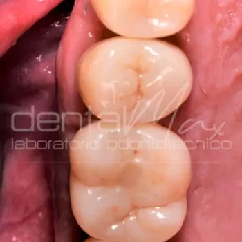 corona dentale in zirconio su impianto