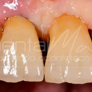 corona dentale in zirconio su impianto