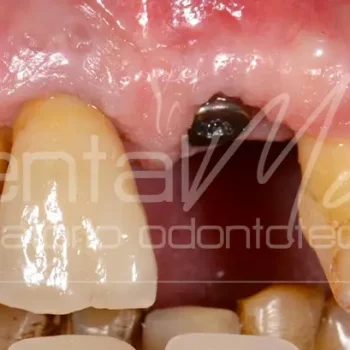 corona dentale in zirconio su impianto