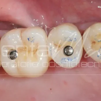 corona-zirconia-impianto-07