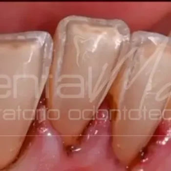 Disilicato IPS emax Dentalmax Volvera